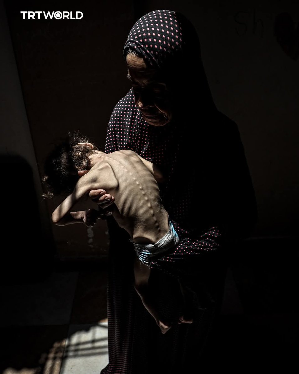 MusaddiqTaxCo's tweet photo. Based on Gaza Ministry of Health data reported via UN/OCHA:

📊 Overall numbers (as of July 15–16, 2025):

Total confirmed killed: approximately 58,573 people  

#IndiaWithPalestine https://t.co/uqeJXKZX7x