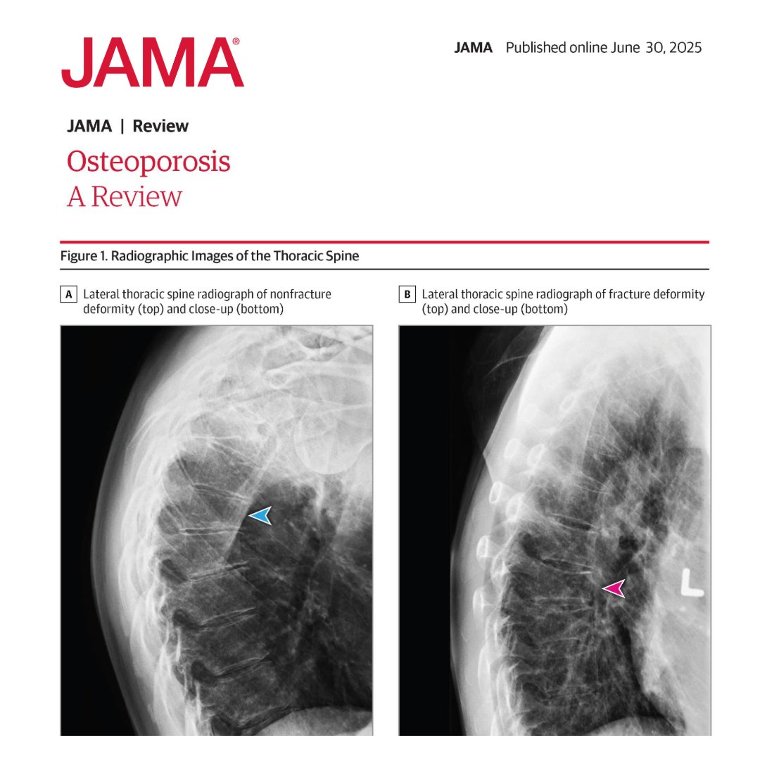 #Osteoporosis is a common condition among older adults that leads to increased susceptibility to fracture.

➡️ Learn more about the epidemiology, diagnosis, and treatment of osteoporosis in this review.

ja.ma/4m0B7SL