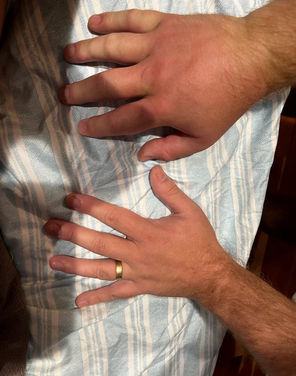 My buddy sent me a pic of his yellow jacket stung hand and asked me if he should go to the doctor.