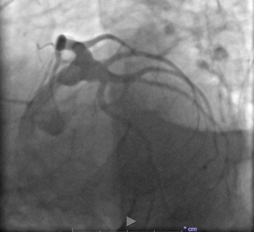 AwfaZain's tweet image. The “Upside Down” Left Main