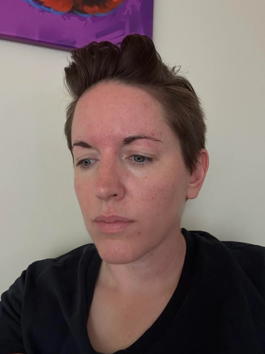 Two weeks on Ivermectin cream