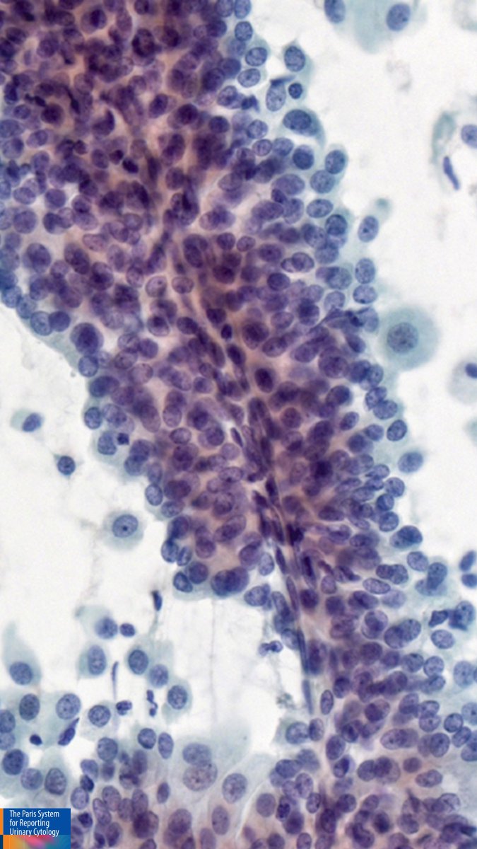 DrCycloPath's tweet photo. Renal pelvis washing reveals a papillary structure.  
What is your interpretation? 🧐
A) High grade urothelial carcinoma (HGUC) 
B) Atypical urothelial cells 
C) Negative for HGUC 
D) Non-urothelial malignancy 
#CytoPath #PathTwitter #Pathology #GUPath https://t.co/0s7O7GRbmr