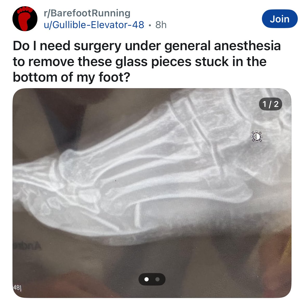 The Barefoot Running subreddit is amazing because half the posts are like “loving the journey so far, however I catastrophically destroyed my foot, any experience with this?”