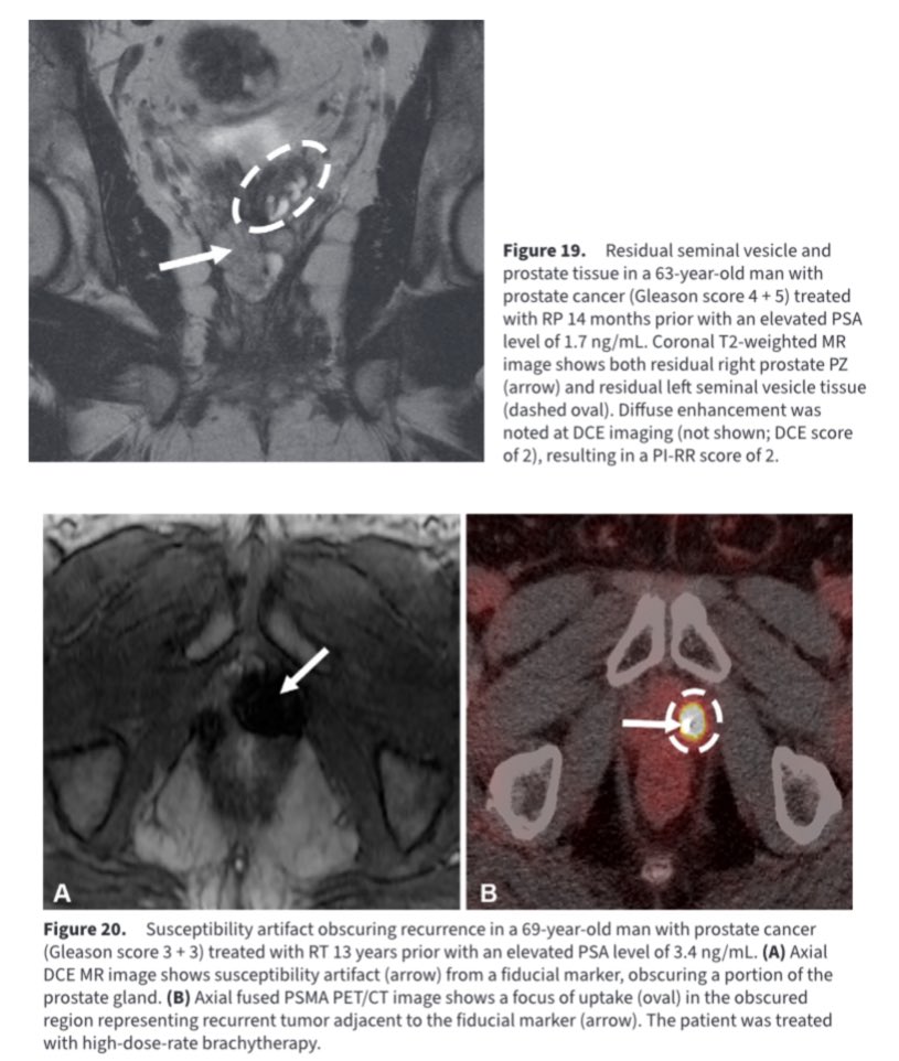 Baris Turkbey MD (@radiolobt) on Twitter photo 📣 Prostate Imaging for Recurrence Reporting: User Guide
👍Very important article on reporting MRI findings in recurrent #prostatecancer
pubs.rsna.org/doi/10.1148/rg…
🥇Congratulations to our colleagues from <a href="/WashUMedMIR/">WashU Medicine Mallinckrodt Institute of Radiology</a>
#prostatecancer #radiology #cancerresearch 📣 Prostate Imaging for Recurrence Reporting: User Guide
👍Very important article on reporting MRI findings in recurrent #prostatecancer
pubs.rsna.org/doi/10.1148/rg…
🥇Congratulations to our colleagues from <a href="/WashUMedMIR/">WashU Medicine Mallinckrodt Institute of Radiology</a>
#prostatecancer #radiology #cancerresearch