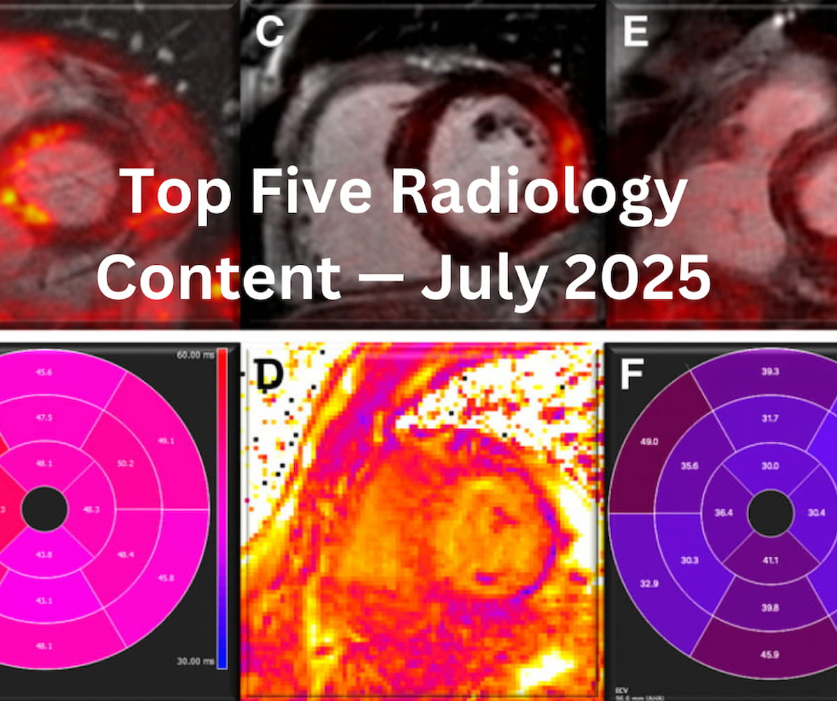 Diagnostic Imaging (@dx_imaging) on Twitter photo Top Five #Radiology Content ā July 2025
diagnosticimaging.com/view/top-five-ā¦
<a href="/RadiologyACR/">American College of Radiology</a> <a href="/ARRS_Radiology/">ARRS</a> <a href="/RSNA/">RSNA</a> <a href="/SNM_MI/">SNMMI</a> <a href="/PennRadiology/">Penn Radiology</a> <a href="/Hopkins_Rad/">Johns Hopkins Radiology</a> <a href="/YaleRadiology/">Yale Department of Radiology & Biomedical Imaging</a> <a href="/UVARadiology/">UVA Radiology</a> <a href="/NYUImaging/">NYU Langone Health Department of Radiology</a> <a href="/BrighamRad/">Brigham and Women's Radiology</a> <a href="/OSURadiology/">Ohio State Radiology</a>
#RadRes Top Five #Radiology Content ā July 2025
diagnosticimaging.com/view/top-five-ā¦
<a href="/RadiologyACR/">American College of Radiology</a> <a href="/ARRS_Radiology/">ARRS</a> <a href="/RSNA/">RSNA</a> <a href="/SNM_MI/">SNMMI</a> <a href="/PennRadiology/">Penn Radiology</a> <a href="/Hopkins_Rad/">Johns Hopkins Radiology</a> <a href="/YaleRadiology/">Yale Department of Radiology & Biomedical Imaging</a> <a href="/UVARadiology/">UVA Radiology</a> <a href="/NYUImaging/">NYU Langone Health Department of Radiology</a> <a href="/BrighamRad/">Brigham and Women's Radiology</a> <a href="/OSURadiology/">Ohio State Radiology</a>
#RadRes