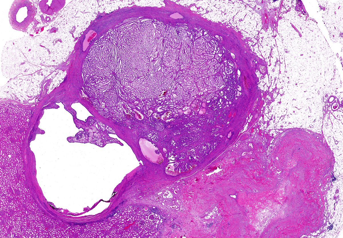 🔬 Can you identify this renal tumor in this low power view? Or is it #TooLowToDiagnose? #GUpath #Pathology #Kidney #KidneyTumors
