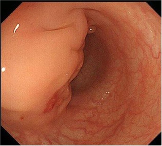 🪞 مرايا طبية: ألم بطن… لكن الجاني خارج الجهاز الهضمي!

سيدة في منتصف الثلاثينات، تعمل وتعتني بأسرتها، جاءت تشتكي من آلام بطن مزمنة، خاصة أسفل البطن والجهة اليسرى.
الألم يشتد قبل الدورة الشهرية ويخف بعدها قليلًا، لكنه بدأ يتداخل مع حياتها اليومية، مصحوبًا أحيانًا بإمساك وانتفاخ،