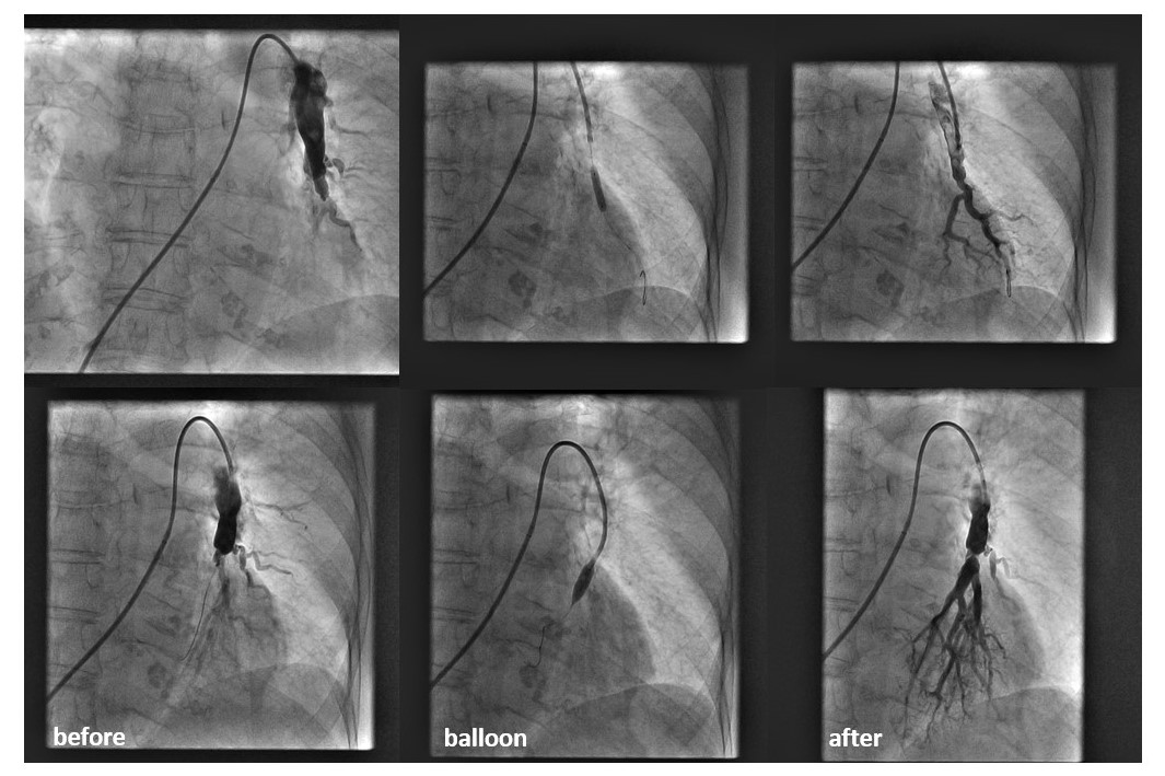 Prva balonska angioplastika plućnih arterija u 🇭🇷 – KBC Split! Ovaj važan iskorak donosi minimalno invazivno liječenje u javni zdravstveni sustav, smanjenje rizika i poboljšanje kvalitete života. Zahvaljujemo timu KBC-a Split što kontinuirano unaprjeđuju skrb za naše pacijente.