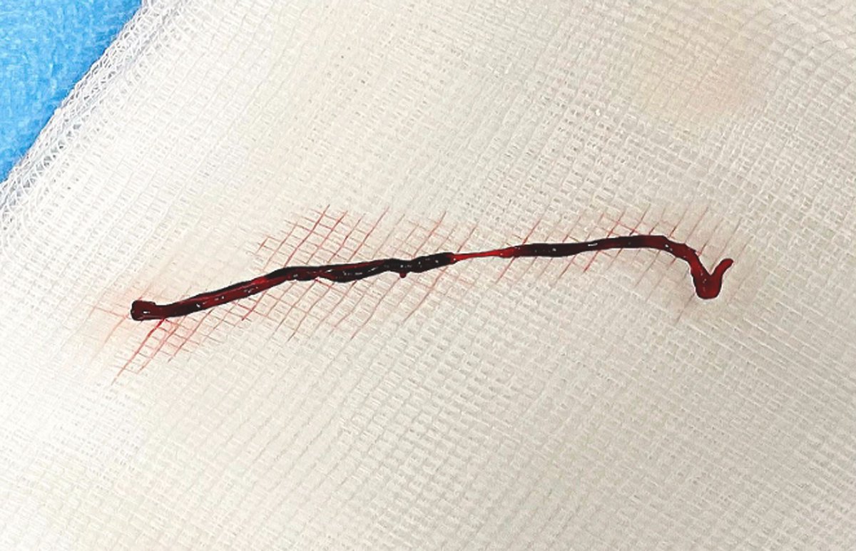 Abdulrahman Arabi (@abdarabi) on Twitter photo An interesting case from our center in JACC case reports:
Young F w STEMI and acute PE found to have a large PFO
The final dx : embolization of malignant tissue
jacc.org/doi/10.1016/j.…
<a href="/MAltermanini/">Mohammad AlTermanini</a> <a href="/AlhijjiM/">Mohammed Al-Hijji</a> <a href="/MSalah/">Mohamed Salah</a> An interesting case from our center in JACC case reports:
Young F w STEMI and acute PE found to have a large PFO
The final dx : embolization of malignant tissue
jacc.org/doi/10.1016/j.…
<a href="/MAltermanini/">Mohammad AlTermanini</a> <a href="/AlhijjiM/">Mohammed Al-Hijji</a> <a href="/MSalah/">Mohamed Salah</a>