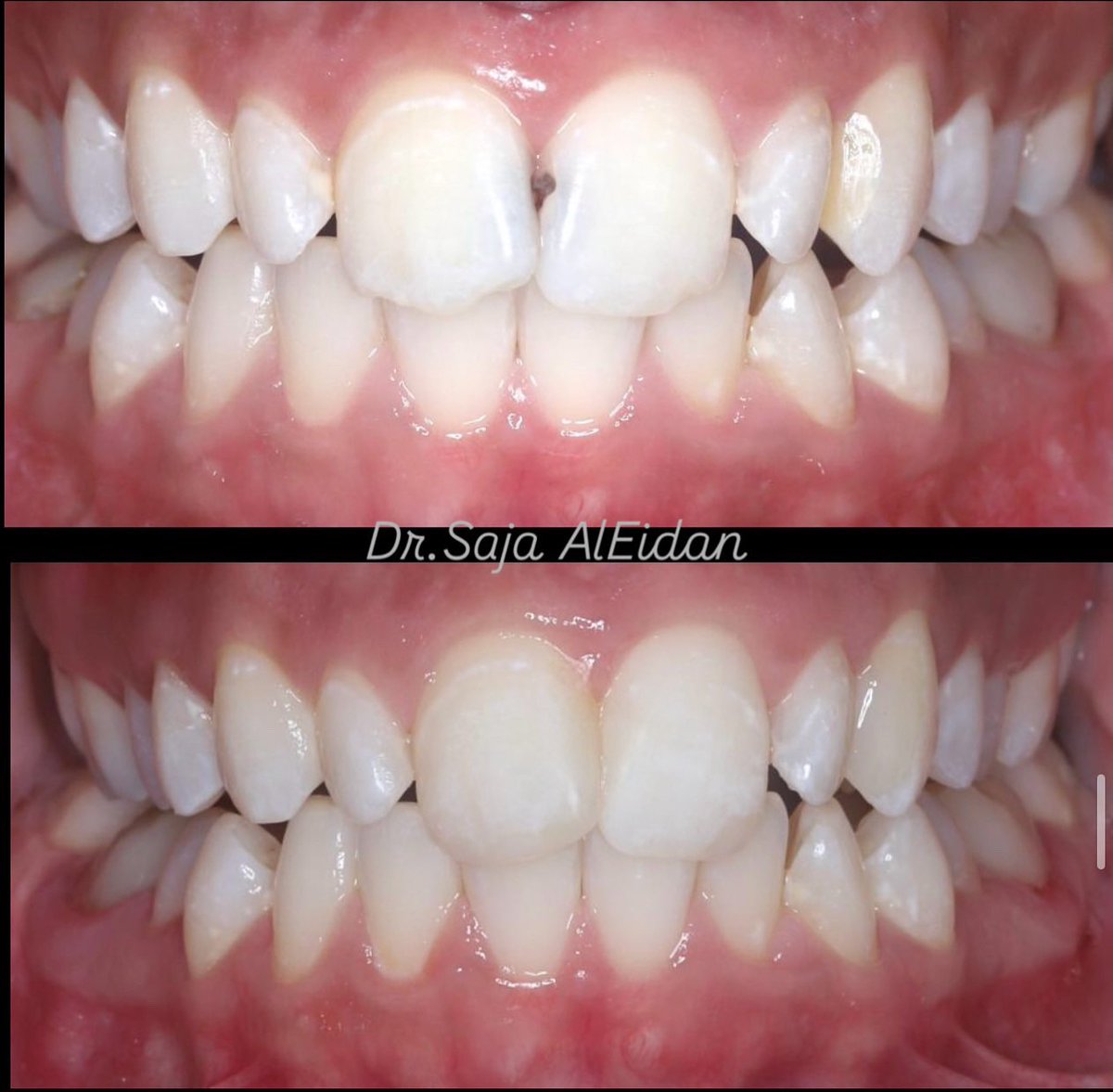 قبل وبعد ✨

تمت إزالة التسوس واستبداله بحشوات تجميلية مطابقة للون السن

#حشوات_تجميليه #حشوات #حشوات_خلفيه #حشوات_أماميه
#اسنان #smile #composite #dentistry