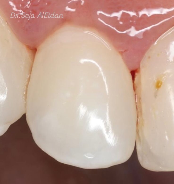 تمت إزالة الحشوة القديمة ومعالجة التسوس وعمل حشوة تجميلية جديدة مطابقة للون وشكل السن الطبيعي✨

#حشوات_تجميليه #حشوات #حشوات_خلفيه #حشوات_أماميه
#اسنان #smile #composite #dentistry