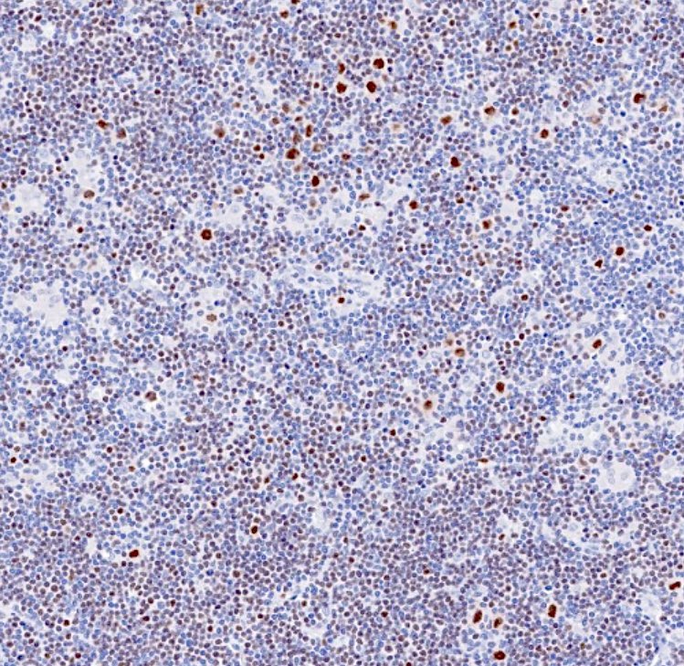 Large mesenteric mass in an 82 yo woman. H&amp;E, IgD, OCT2. No other involvement on PET CT 👀🫨 Your diagnosis?