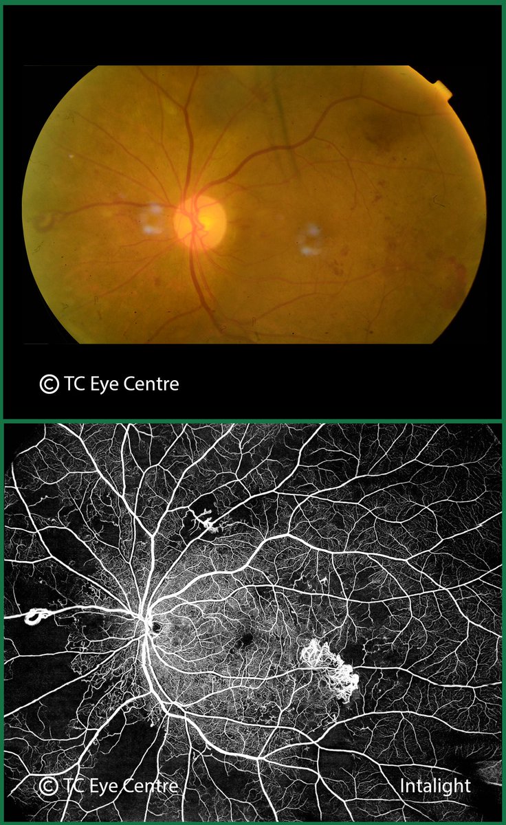 UpshamGoel's tweet photo. 🔔 Diabetic Retinopathy (DR) is a leading cause of blindness across the world - And mostly because it is often detected late,
Now a revolutionary new technology called UWA-OCTA can detect the earliest changes of Diabetic Retinopathy with just a quick Scan, and without injections. https://t.co/Xu7jdv7dCy