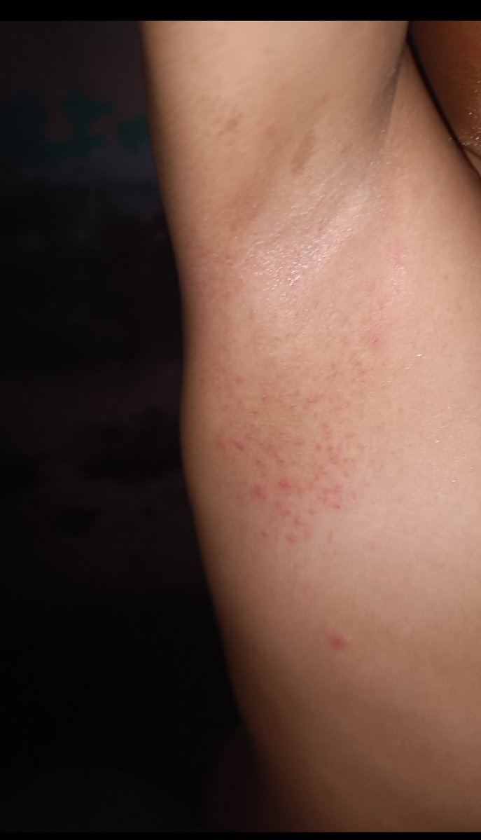 🚨 URGENT 🚨
My son has a skin infection from dirty water and no hygiene.
He’s in pain. Please help me treat him.
If you see this reply with a dot. it's just a dot.
chuffed.org/project/eslamo…