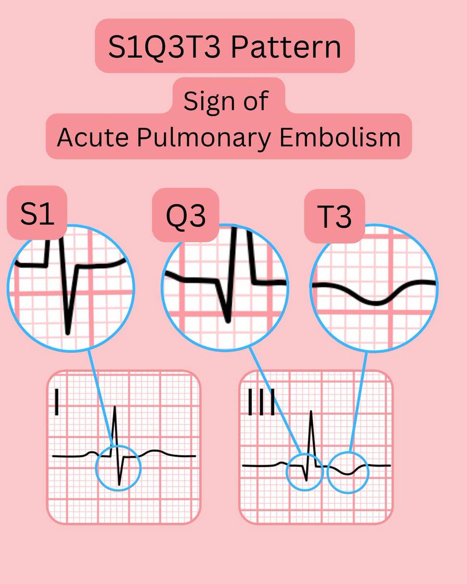 The S1Q3T3 pattern, a significant ECG finding indicative of acute pulmonary embolism (PE). 

threads.com/@ecgsmart/