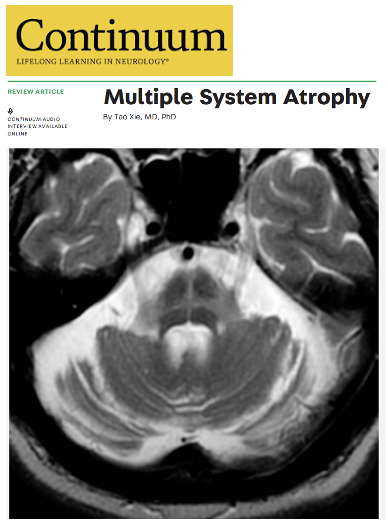 MichaelOkun's tweet photo. Check out this 2025 update on the diagnosis and treatment of MSA by Tao Xie from the University of Chicago in the AAN's newest Continuum issue on Movement Disorders. Spoiler alert: MSA is a whole body disease and more than just the brain. How about that MRI hot cross buns sign?
Key Points:
- New diagnostic criteria have arrived.
- The 2022 International Parkinson and Movement Disorder Society (MDS) criteria sharpen our ability to diagnose MSA earlier, adding categories like prodromal possible MSA to catch the disease in its earliest stages.
- Imaging and biomarkers are leading the way. MRI techniques may reveal a hot cross bun sign or putaminal atrophy.
- There is a new MRI AI system called AIDP that differentiates MSA, PD and PSP.
- α-synuclein seed amplification assays are now showing real promise for differentiating MSA from Parkinson’s and other look-alikes.
- Management remains multidisciplinary.
- There are no disease modifying therapies yet, however a multisystem approach targeting autonomic failure, parkinsonism, ataxia and palliative care can be critical for maintaining quality of life.
My take: First, for those who have MSA, I want you to be careful interpreting what is in the literature. Though some cases have faster progression than Parkinson's, not all cases in my practice progress rapidly. Some case respond well to levodopa, for example. These 5 points resonated w/ me about Tao's article. 1- MSA is not Parkinson’s. It’s a relatively rare but aggressive condition that affects movement, balance and automatic body functions like blood pressure and bladder control. 2- Diagnosis can be tricky, however we are getting better. Health care professionals now have better tools like specialized brain scans and new lab tests to catch MSA earlier and more accurately. 3- It’s a whole body disease and not just the brain. MSA hits multiple systems: walking becomes difficult, blood pressure drops when standing and even speech and swallowing can be affected, not to mention the skin and GI tract. 4- Treatments focus on easing symptoms and include physical therapy, medications and supportive care and they can make a real difference in daily life. Don't forget to aggressively treat depression, apathy and demoralization. 5- Great hope is in emerging research. Scientists are racing to find disease-modifying treatments and there are new studies on biomarkers and cell therapies pointing us in the right direction.
https://t.co/b4H581W2NN #Parkinson @ParkinsonDotOrg @FixelInstitute @ContinuumAAN @AANmember