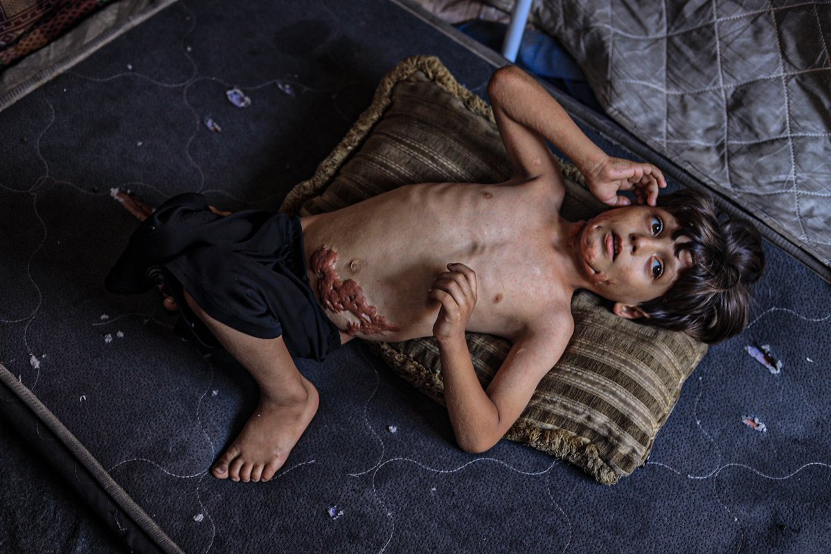HaninMahir96's tweet photo. Mohammed Ma’rouf, 6, hasn’t spoken since fire consumed his body in a Jabalia school a year ago. Hunger stole what war hadn’t. He stands silent— a mirror of Gaza’s children: burned souls in a world that looks away.

By : Haneen Salem
#Gaza  #ChildrenOfWar #CeasefireNow #Palestine https://t.co/I7L7pmxhwp