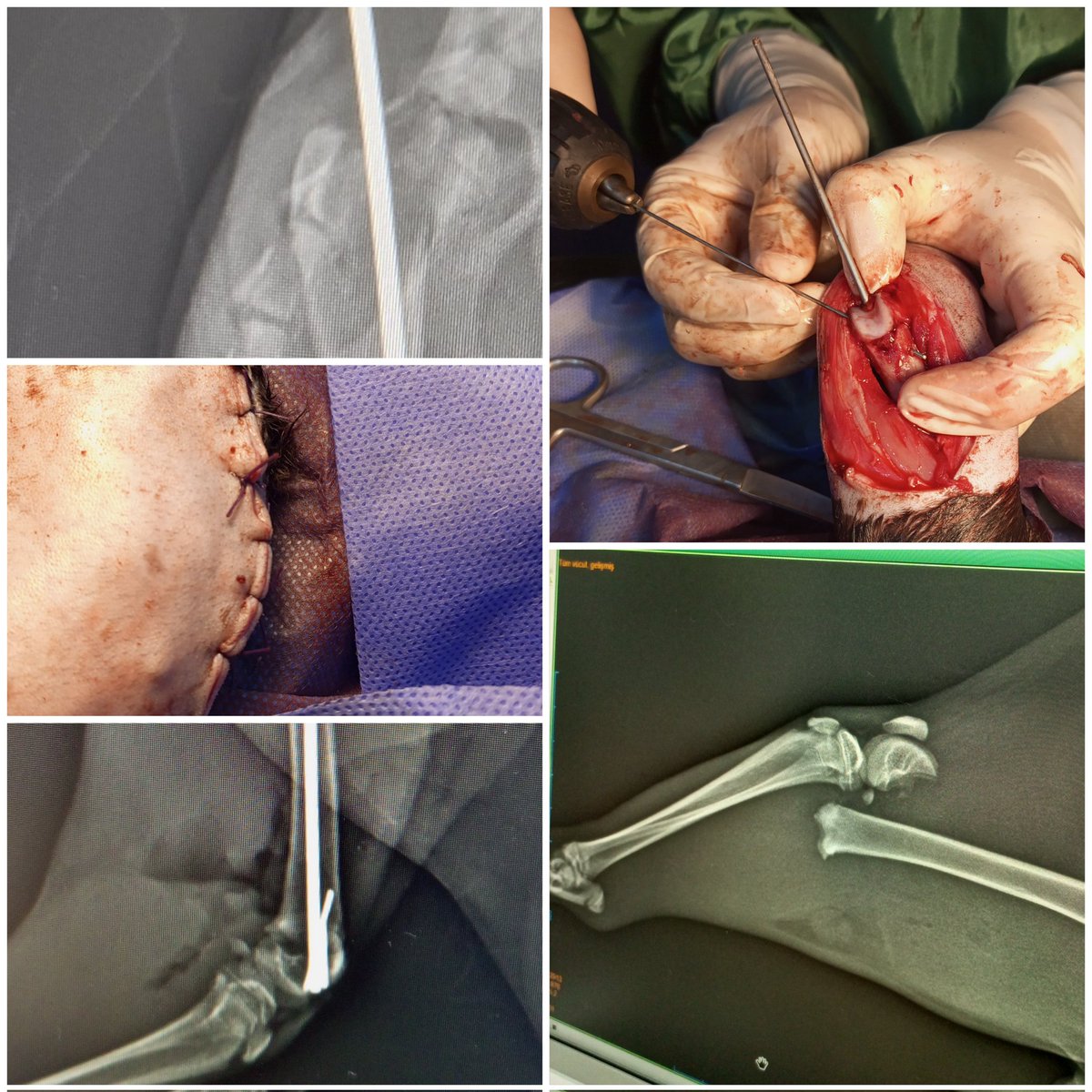 🐾 Öncesi / Sonrası ✨
Başka klinikten yapılamaz diye gönderilen 
Minik patili dostumuz ciddi bir femur kırığıyla kliniğimize geldi.
Titiz bir operasyon ve sevgi dolu bakımın ardından… işte sonuç!
Artık iyileşme yolunda emin adımlarla yürüyor.