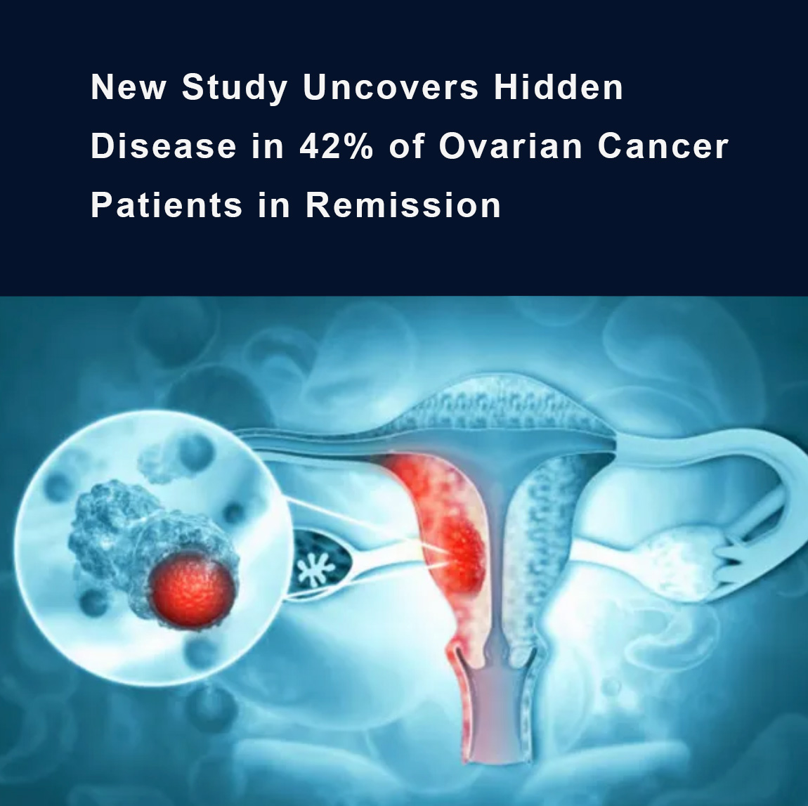A new study found that 42% of #ovariancancer patients in #remission still harbored minimal residual disease (#MRD), undetectable by scans. MRD was linked to worse survival, PFS dropped from 23.8 to 7.4 months. #ctDNA testing revealed hidden #cancer ...
healthandpharma.net/hidden-disease…