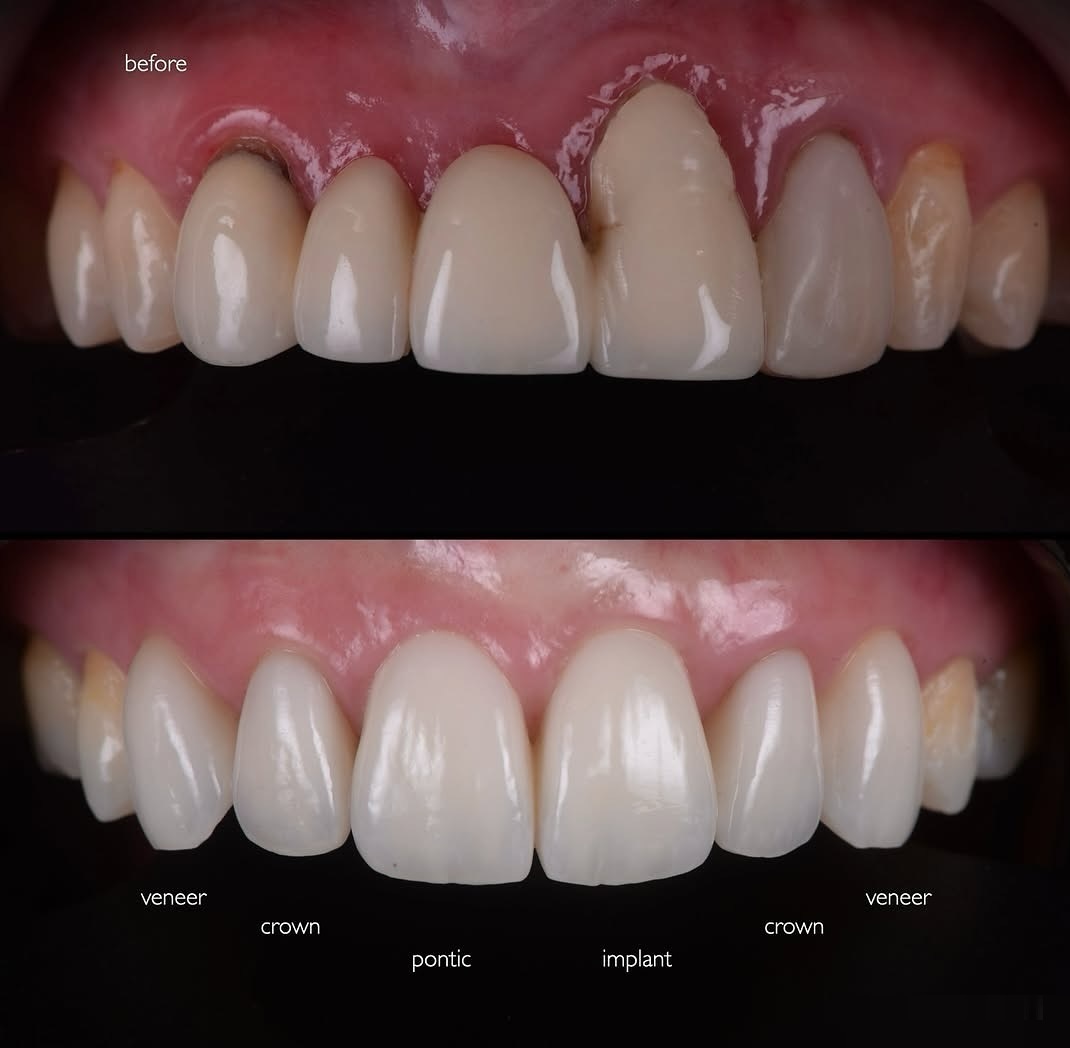 Transformative Smile Makeover Before and After