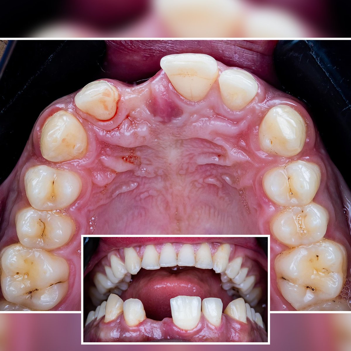 Fully Guided Implant placement with simultaneous GBR