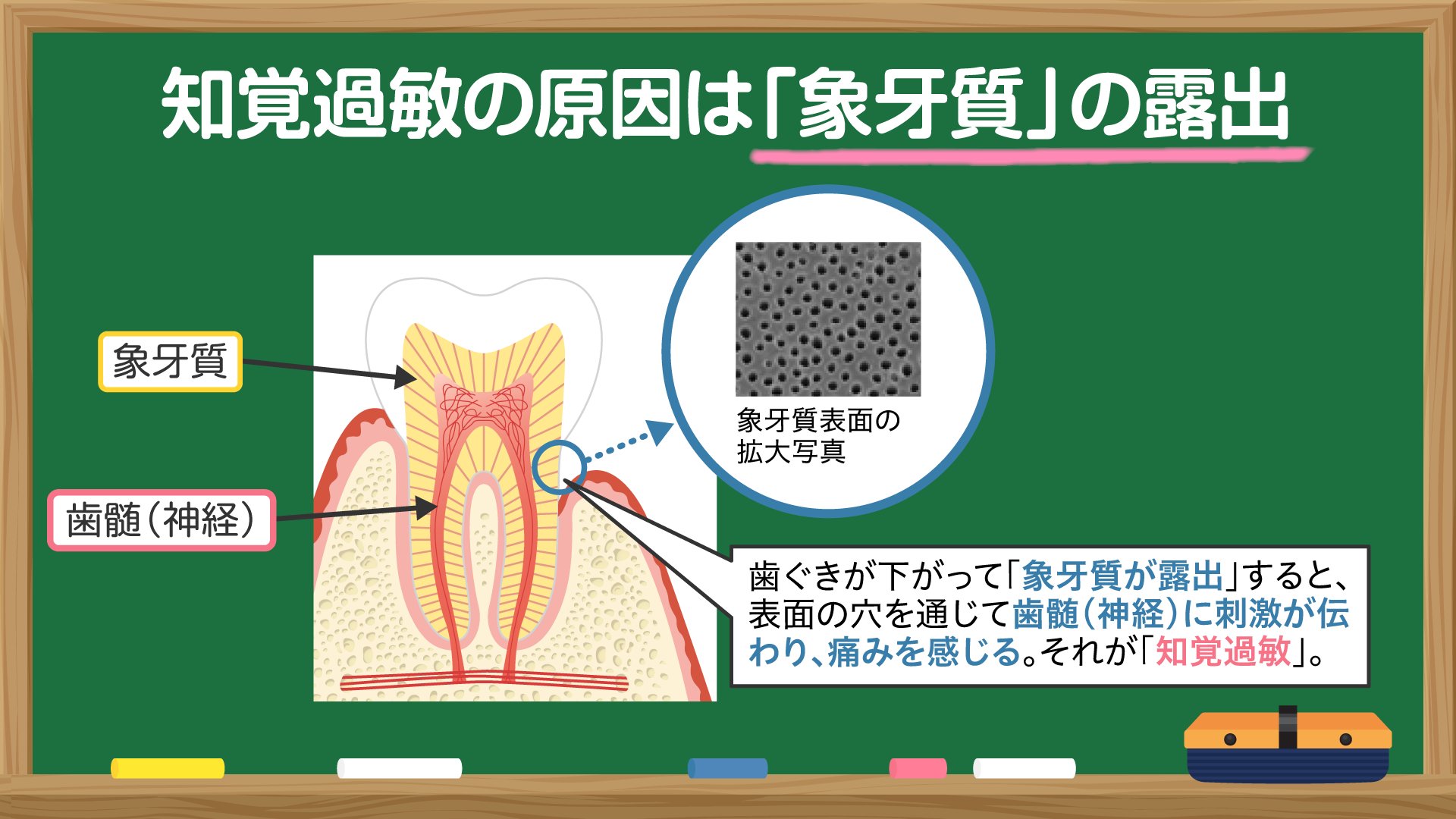 その痛みに寄り添いた!象牙質知覚過敏症 デンタルハイジーン別冊 その痛みに寄り添いたい! 象牙質知覚