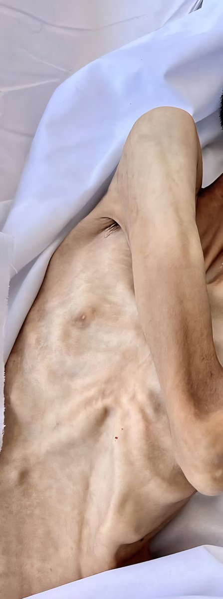 مات جائعًا في غزة، لا لأن الطعام فُقِد من الأرض، بل لأن الرحمة فُقِدت من القلوب؛ جاع حتى برزت عظامه من تحت جلده، وتحوّل جسده إلى هيكل عظمي يشهد على صمت العالم الذي ادّعى الإنسانية وهو يراه يحتضر دون أن يحرّك ساكنًا.