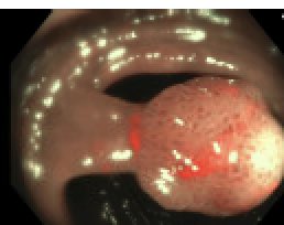EUSandEndoscopy's tweet image. Nice example of classic #pedunculated Paris 0-lp #TubularAdenoma in sigmoid colon. Cold snare or hot snare #polypectomy with #Endocut or #CoagulationCautery (yellow or blue pedal)? Pre clip? Post clip? No clip?