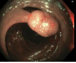 EUSandEndoscopy's tweet image. Nice example of classic #pedunculated Paris 0-lp #TubularAdenoma in sigmoid colon. Cold snare or hot snare #polypectomy with #Endocut or #CoagulationCautery (yellow or blue pedal)? Pre clip? Post clip? No clip?