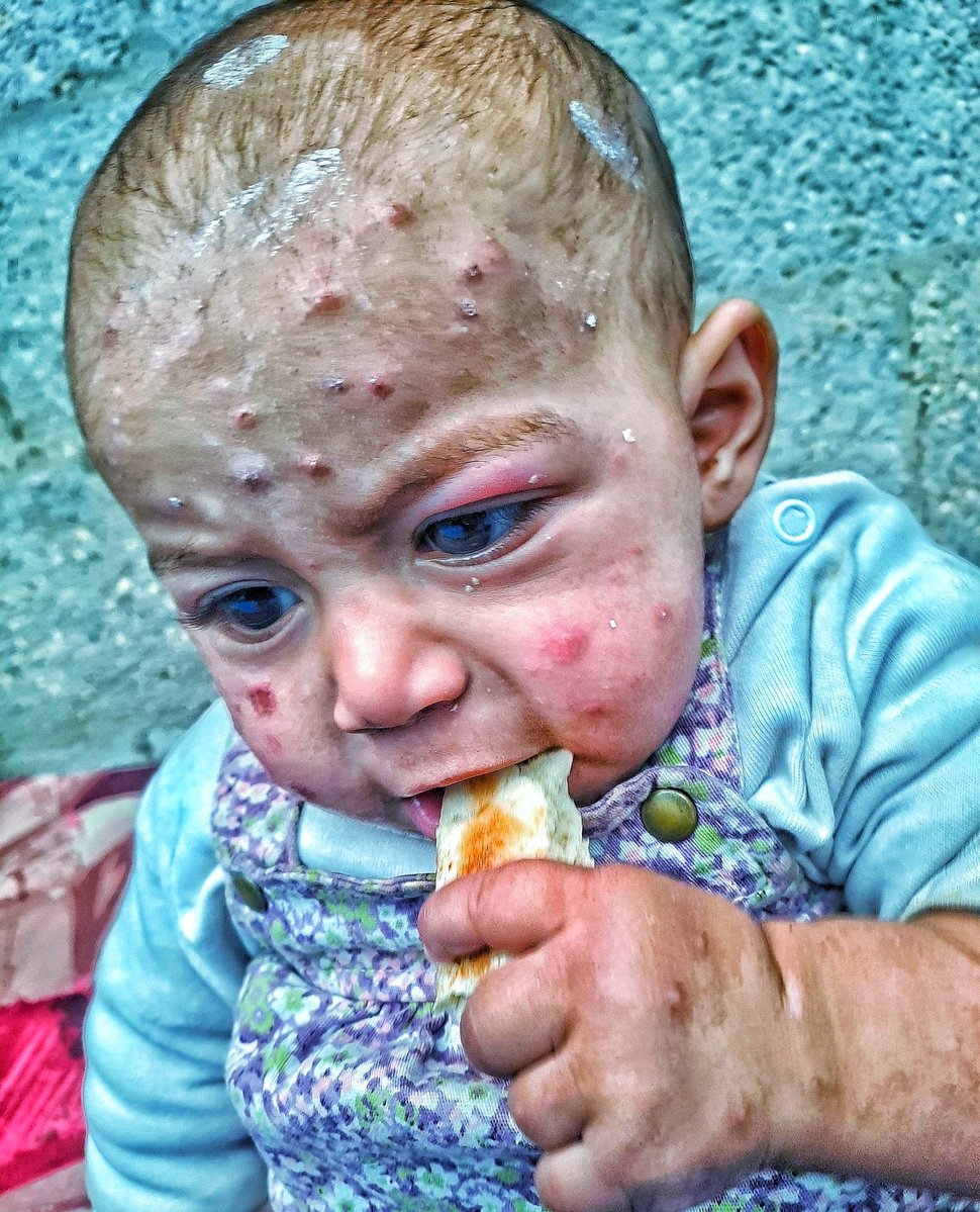 Please don't skip my . Tasneem's eye is swelling rapidly, and the swelling hurts more whenever she cries. Her face is covered in pimples, and the pimples are spreading quickly to her body, causing her severe burning and excruciating pain. Tasneem is finding no relief. The harsh