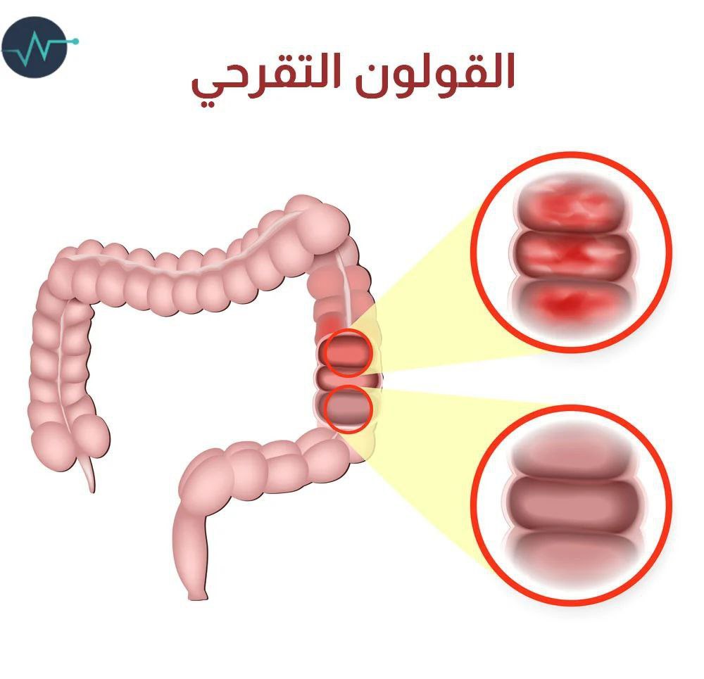 قد لا تصدق 
فوائد التدخين ( مادة النيكوتين)👇
t.me/Human_medicine…
#جرعة_صحة