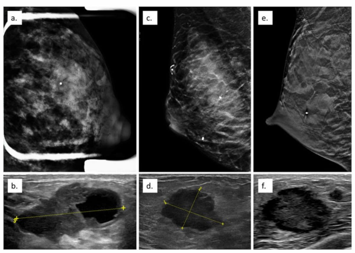 Diagnostic Imaging (@dx_imaging) on Twitter photo New Study Examines Impact of #Mammography in Detecting Pregnancy-Associated #BreastCancer
diagnosticimaging.com/view/new-studyā¦
<a href="/RadiologyACR/">American College of Radiology</a> <a href="/ARRS_Radiology/">ARRS</a> <a href="/RSNA/">RSNA</a> <a href="/JBI_SBI/">Journal of Breast Imaging</a> <a href="/BreastImaging/">Society of Breast Imaging</a> <a href="/SBIRFS/">SBI RFS</a> <a href="/Hopkins_Rad/">Johns Hopkins Radiology</a> <a href="/PennRadiology/">Penn Radiology</a> <a href="/NYUImaging/">NYU Langone Health Department of Radiology</a> <a href="/YaleRadiology/">Yale Department of Radiology & Biomedical Imaging</a> <a href="/DukeRadiology/">Duke Radiology</a>
#radiology #RadRes New Study Examines Impact of #Mammography in Detecting Pregnancy-Associated #BreastCancer
diagnosticimaging.com/view/new-studyā¦
<a href="/RadiologyACR/">American College of Radiology</a> <a href="/ARRS_Radiology/">ARRS</a> <a href="/RSNA/">RSNA</a> <a href="/JBI_SBI/">Journal of Breast Imaging</a> <a href="/BreastImaging/">Society of Breast Imaging</a> <a href="/SBIRFS/">SBI RFS</a> <a href="/Hopkins_Rad/">Johns Hopkins Radiology</a> <a href="/PennRadiology/">Penn Radiology</a> <a href="/NYUImaging/">NYU Langone Health Department of Radiology</a> <a href="/YaleRadiology/">Yale Department of Radiology & Biomedical Imaging</a> <a href="/DukeRadiology/">Duke Radiology</a>
#radiology #RadRes