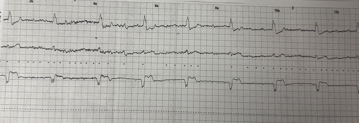 ST4_Cardiology's tweet photo. A 78-year-old woman presents with multiple collapses with brief loss of consciousness over 3 weeks. 
She has a past medical history of HTN and RA.

What does her ECG show? 

Subscribe now to https://t.co/qex694qTzM; the ultimate resource for Cardiology interview preparation. https://t.co/a4Trz16rSY