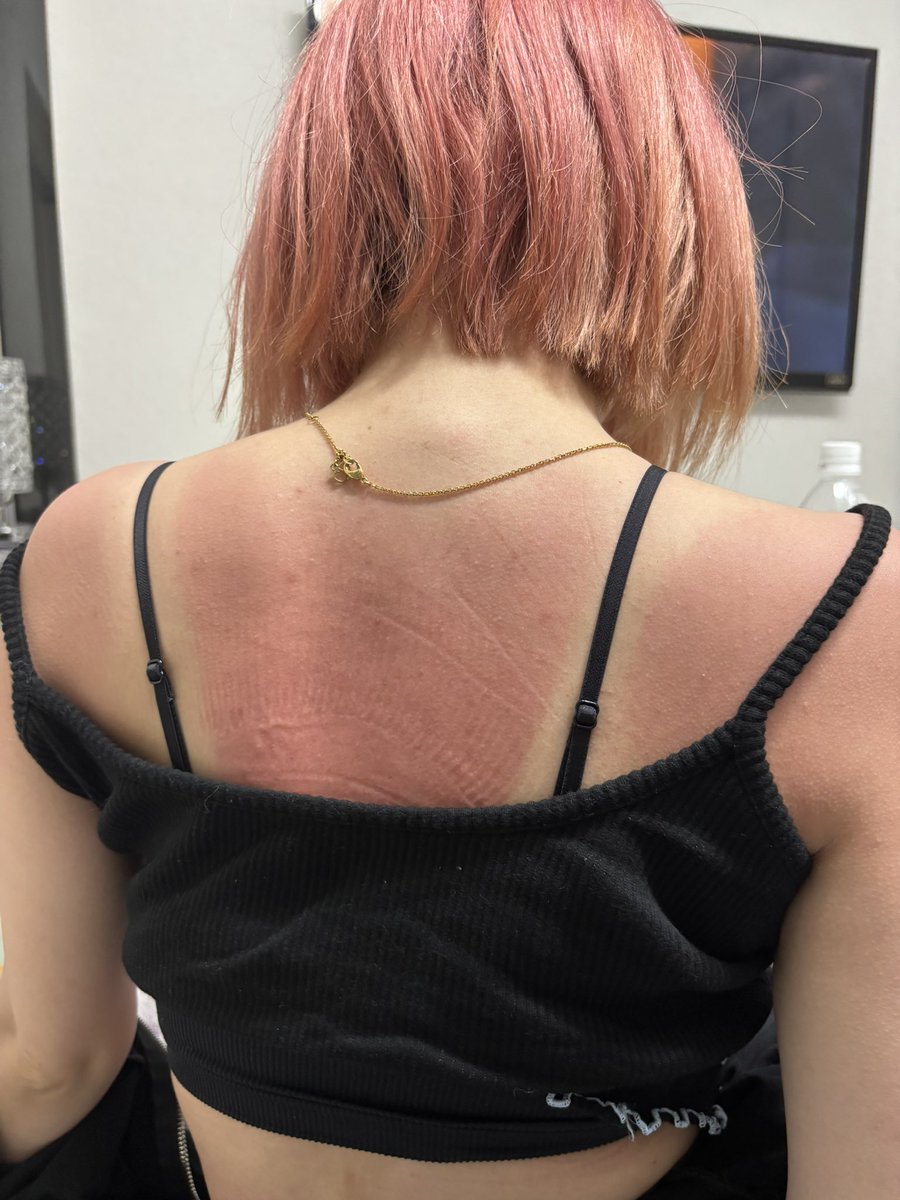 総勢約20人で川にBBQに行き
女2人だったため
女を捨てた遊び方して（いつも）
背中だけ日焼け止め塗るのを忘れて
背中死亡しました😇

もし私が泣いても背中をさすらないでね
（？！）