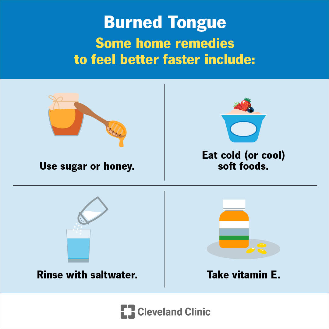 Consuming hot foods and beverages can cause you to burn your tongue. Although tongue burns are unpleasant, they’re usually not serious. Drinking cold beverages and eating soft, cool foods can help. Pain medications, like over-the-counter NSAIDs, can relieve pain and inflammation.