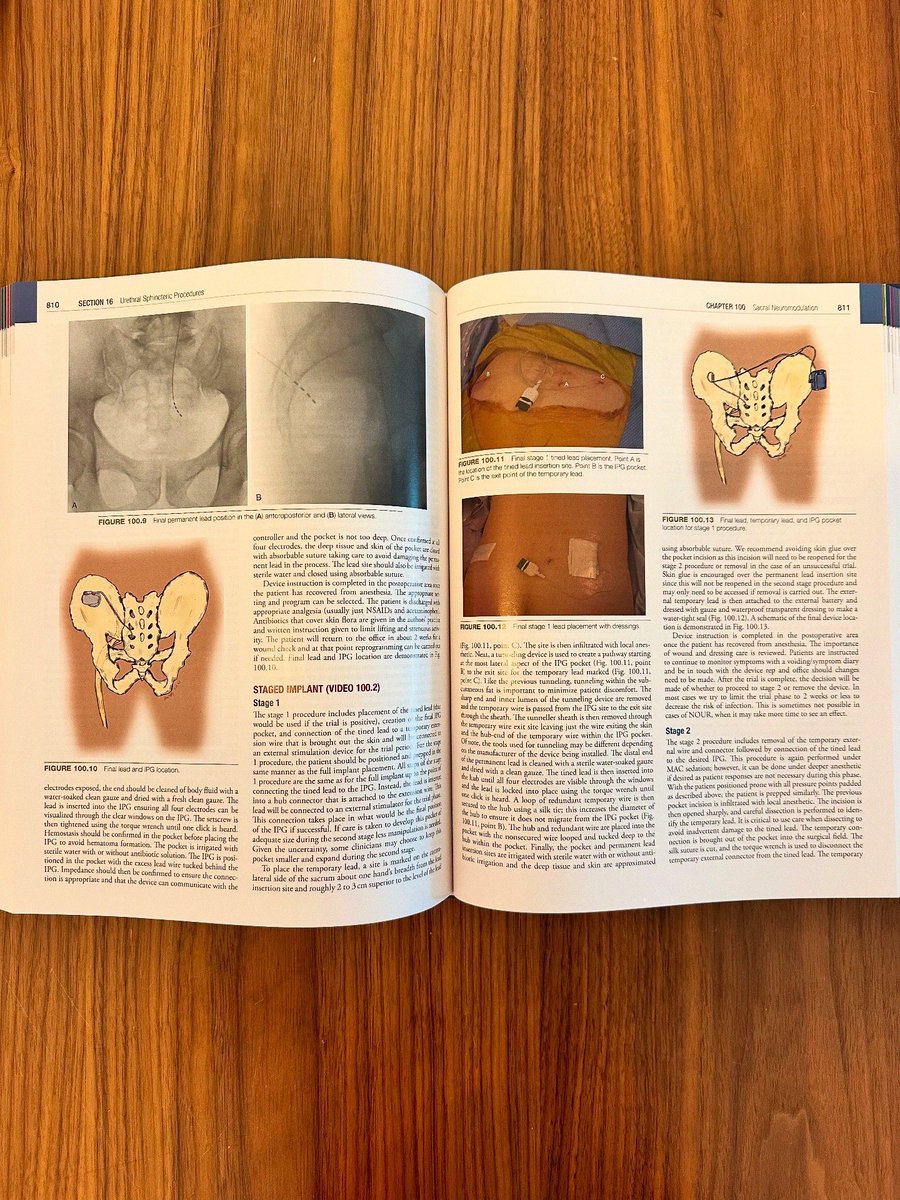 Yeonsoo Sara Lee, MD (@ysaralee) on Twitter photo Grateful to illustrate ✍🏼 for two chapters in <a href="/ElsevierConnect/">Elsevier</a> Campbell-Walsh-Wein’s Urology & Hinman’s Urologic Surgery 📖 — references I use to prep for surgery, boards, & residency in general! Biggest thanks to <a href="/CaseySeidemanMD/">Casey Seideman MD</a> & <a href="/MCWasserMD/">Meredith C Wasserman, MD</a> for the opportunity. Grateful to illustrate ✍🏼 for two chapters in <a href="/ElsevierConnect/">Elsevier</a> Campbell-Walsh-Wein’s Urology & Hinman’s Urologic Surgery 📖 — references I use to prep for surgery, boards, & residency in general! Biggest thanks to <a href="/CaseySeidemanMD/">Casey Seideman MD</a> & <a href="/MCWasserMD/">Meredith C Wasserman, MD</a> for the opportunity.