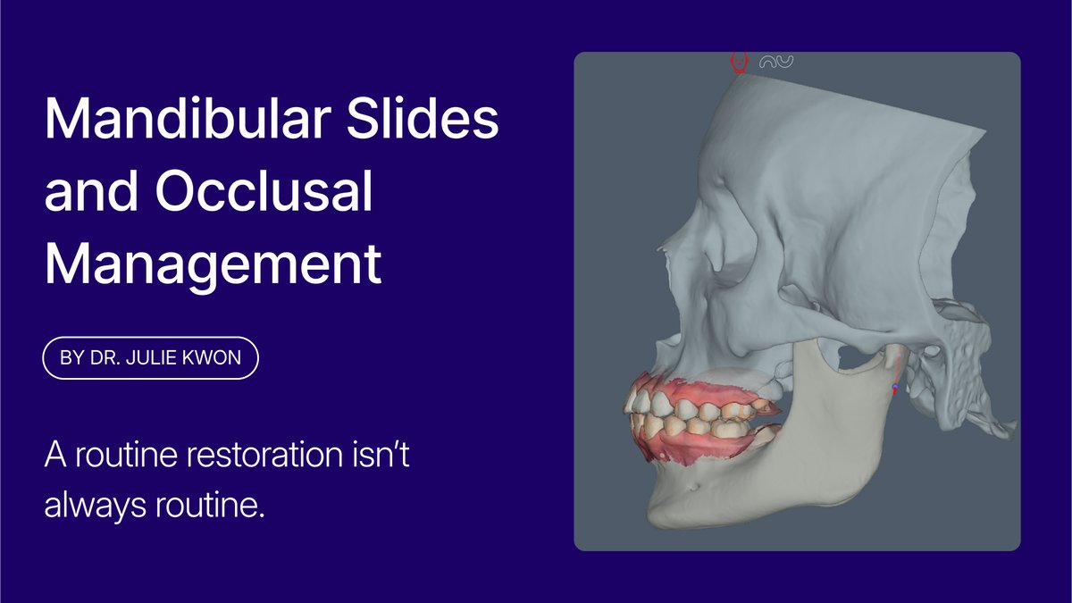 A simple molar restoration can hide complex occlusal risks. 

In her latest Digest article, Dr. Julie Kwon shares how to spot slides over 2mm before treatment. 

👉 hubs.li/Q03zpznk0