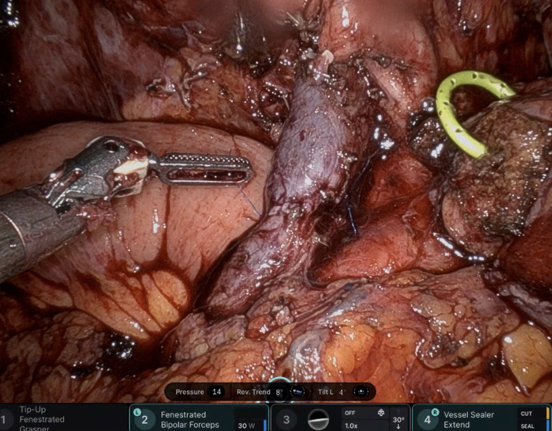 Zhi Ven Fong, MD MPH DrPH (@zhivenfongmd) on Twitter photo <a href="/ziadtawad/">Ziad Awad, MD, FACS</a> <a href="/SyedAAhmad5/">Syed A. Ahmad</a> Agreed! Wish I had mobilized more in this case to do that as <a href="/SyedAAhmad5/">Syed A. Ahmad</a> also pointed out. Defect was larger than I expected prob cause of 🤖magnification.
This was an end-to-end last month. I did divide the splenic vein & IMV for it to come together nicely and tension-free. <a href="/ziadtawad/">Ziad Awad, MD, FACS</a> <a href="/SyedAAhmad5/">Syed A. Ahmad</a> Agreed! Wish I had mobilized more in this case to do that as <a href="/SyedAAhmad5/">Syed A. Ahmad</a> also pointed out. Defect was larger than I expected prob cause of 🤖magnification.
This was an end-to-end last month. I did divide the splenic vein & IMV for it to come together nicely and tension-free.