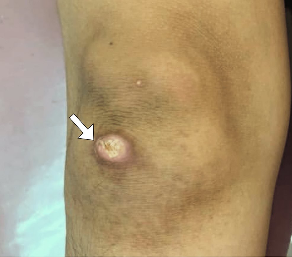 Diagnosis in this painless lesion?  Source: Cureus