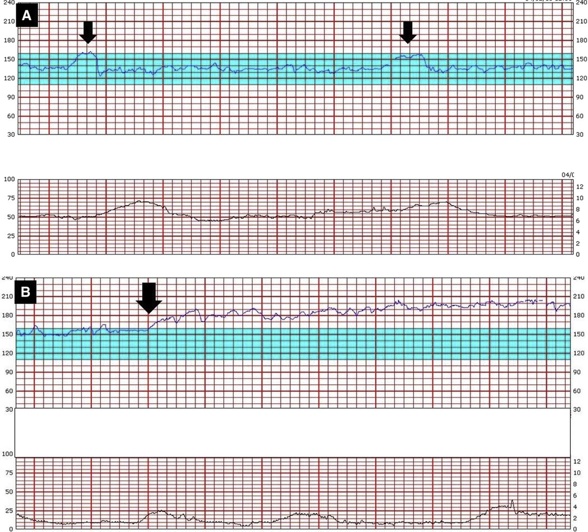 AJOG_thegray's tweet photo. AJOG Expert Review in Labor:  Abnormal fetal heart rate patterns caused by pathophysiologic processes other than fetal acidemia - FHR pattern changes caused by acute CNS injury during labor because of middle cerebral artery occlusion or thrombosis https://t.co/si5OsntpRs https://t.co/MCSMxjZa9C