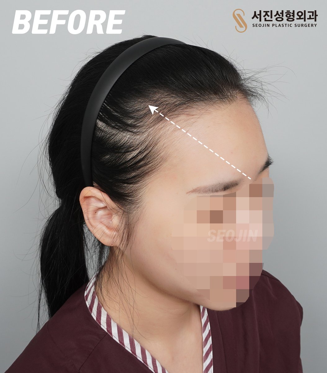 seojinps_eng's tweet photo. A deep M-shaped hairline can make your face look less defined.
Seojin Hair Transplant offers a scar-free way to fill in the hairline and create a smaller, more balanced look!
#HairTransplant #ForeheadReduction #HairlineCorrection #Hairloss #HairTransplantKorea #Kbeauty #Kpop https://t.co/GLyByGDZCo