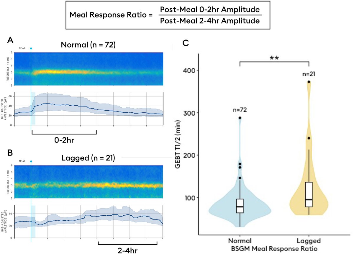 NGMJournal's tweet photo. @maura_corsetti @IBS_Maastricht @DrCJBlack @AndreaShin_GI @mpj61 @nicolascenac @ThisIsButt @Pierfra_Visaggi @Rajan___Singh @SSrinivasanMD @karagm2009 @LindaNguyenMD @BMoshiree @LinChangMD @KashyapPurna @mgrover_gi @BeyderLab @esnm_eu @ANMSociety 🔥Combining #BodySurfaceGastricMapping with #GastricEmptyingBreathTesting identifies distinct #Gastroparesis subgroups⏩A novel lagged meal response linked to delayed GE‼️
🎯Mechanism-based phenotypes of #gastroparesis based on simultaneous #BSGM & #GEBT
👉https://t.co/GBDu1QTv1X https://t.co/zeFJF0pylP