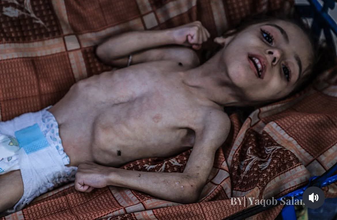 Hunger in Gaza is no longer just a humanitarian crisis, but an ongoing crime against a besieged people who face death every day. When hunger continues, everything stops: childhood, hope, and even breathing. Gaza is suffocating! <a href="/yaqob/">yaqob</a>.salama