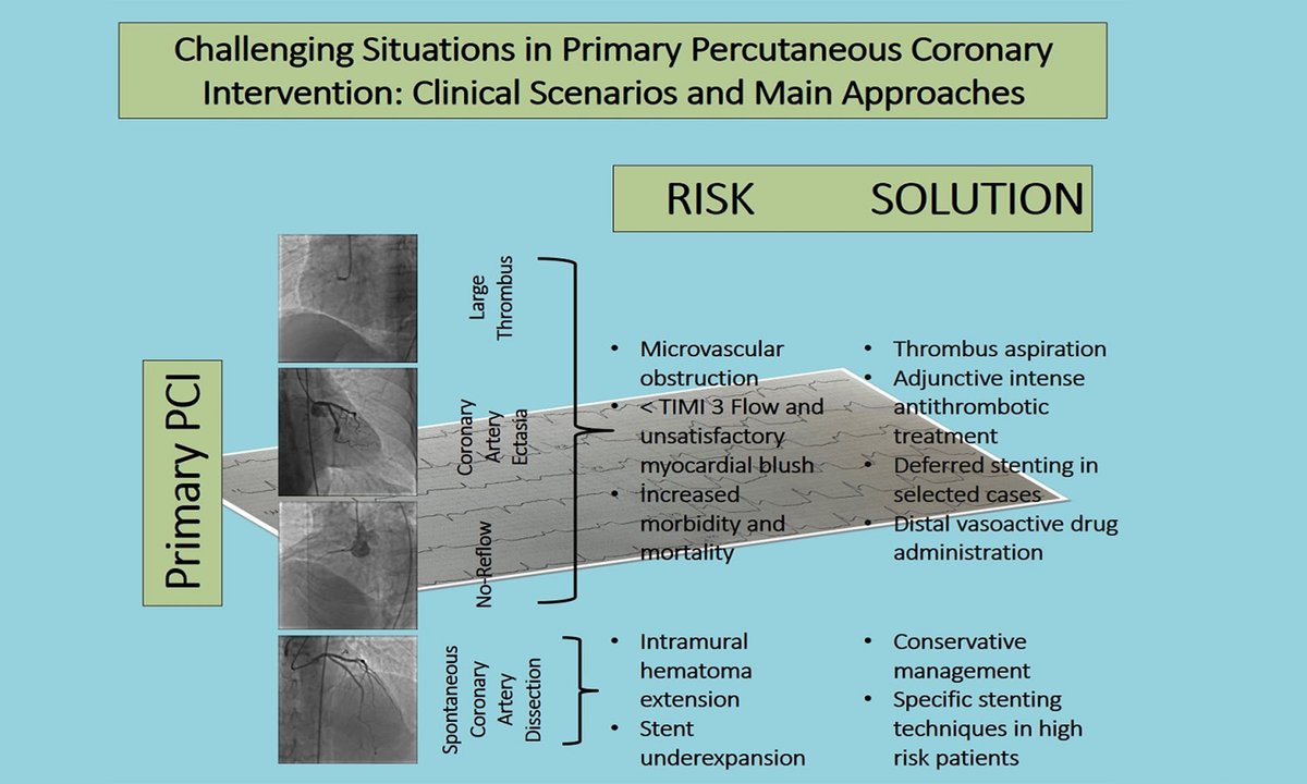 Vessel Plus (@vessel_plus) on Twitter photo Nice review from <a href="/Vessel_Plus/">Vessel Plus</a> ! 👏
🚨Key challenges situations include no-reflow, large thrombotic lesions, coronary artery ectasia, and #SCAD.
💡 Management: Thrombus aspiration, drugs, deferred stenting. #CardioTwitter #PCI #CoronaryArtery
🔗oaepublish.com/articles/2574-… Nice review from <a href="/Vessel_Plus/">Vessel Plus</a> ! 👏
🚨Key challenges situations include no-reflow, large thrombotic lesions, coronary artery ectasia, and #SCAD.
💡 Management: Thrombus aspiration, drugs, deferred stenting. #CardioTwitter #PCI #CoronaryArtery
🔗oaepublish.com/articles/2574-…