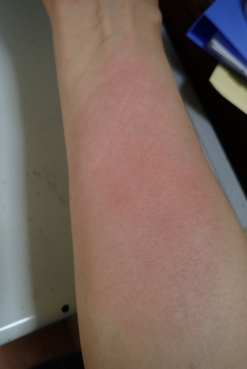 Eupithecia_moth's tweet image. アブに刺された