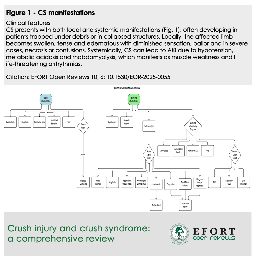 #EOR -Comprehensive review of #CrushSyndrome! 🚨 Early aggressive fluid resuscitation is paramount. Key insights on pathophysiology, controversies &amp; multidisciplinary care for this life-threatening condition

🔗bit.ly/EOR250612

#CrushInjury #AKI #EmergencyMedicine #EFORT