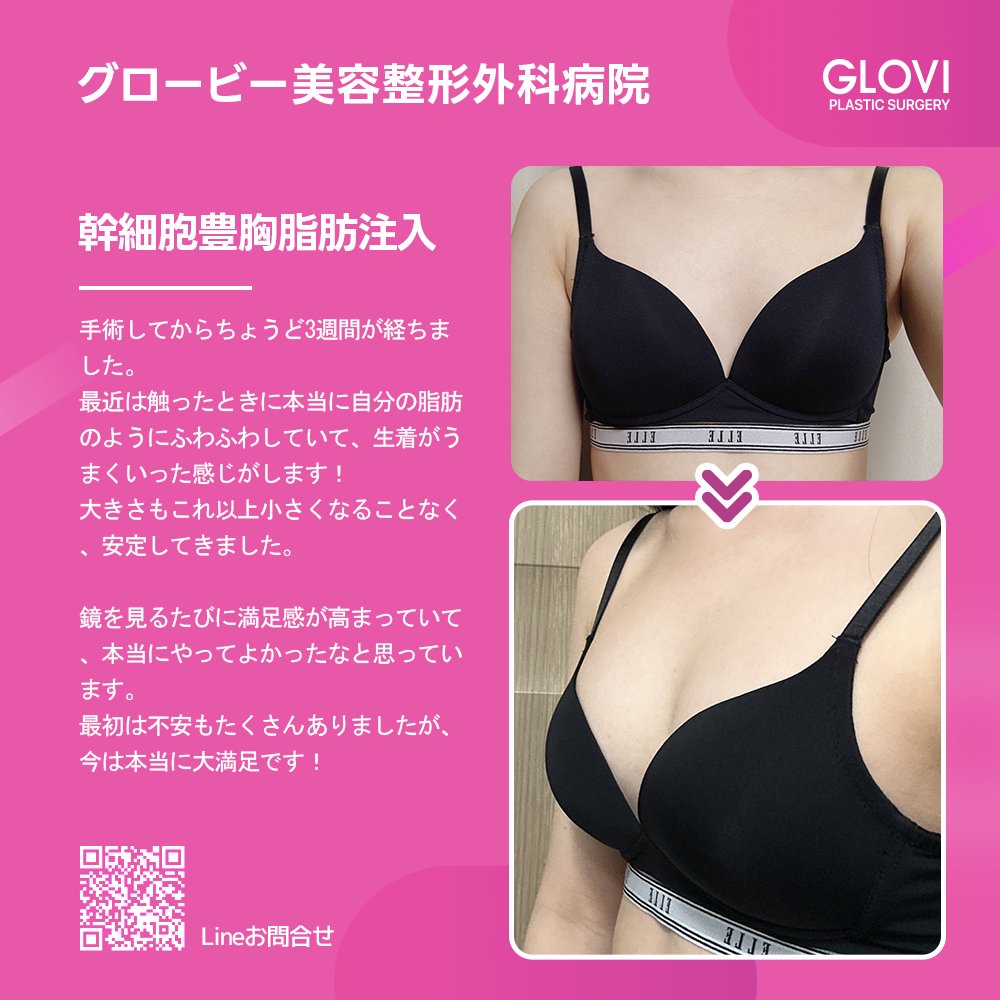 GloviPlastic's tweet photo. ✨脂肪でナチュラルに、幹細胞でハリと弾力を！

ボリューム＋触感＋持続力をすべて叶えましょう💗
自然なバストラインを目指すなら今がチャンス！
Line：https://t.co/ikxgv8GeYO 
#Glovi #脂肪豊胸 #幹細胞バスト #セルラーファット #バストアップ #ナチュラルバスト #脂肪注入 #幹細胞脂肪注入 https://t.co/pTiBs3En0D