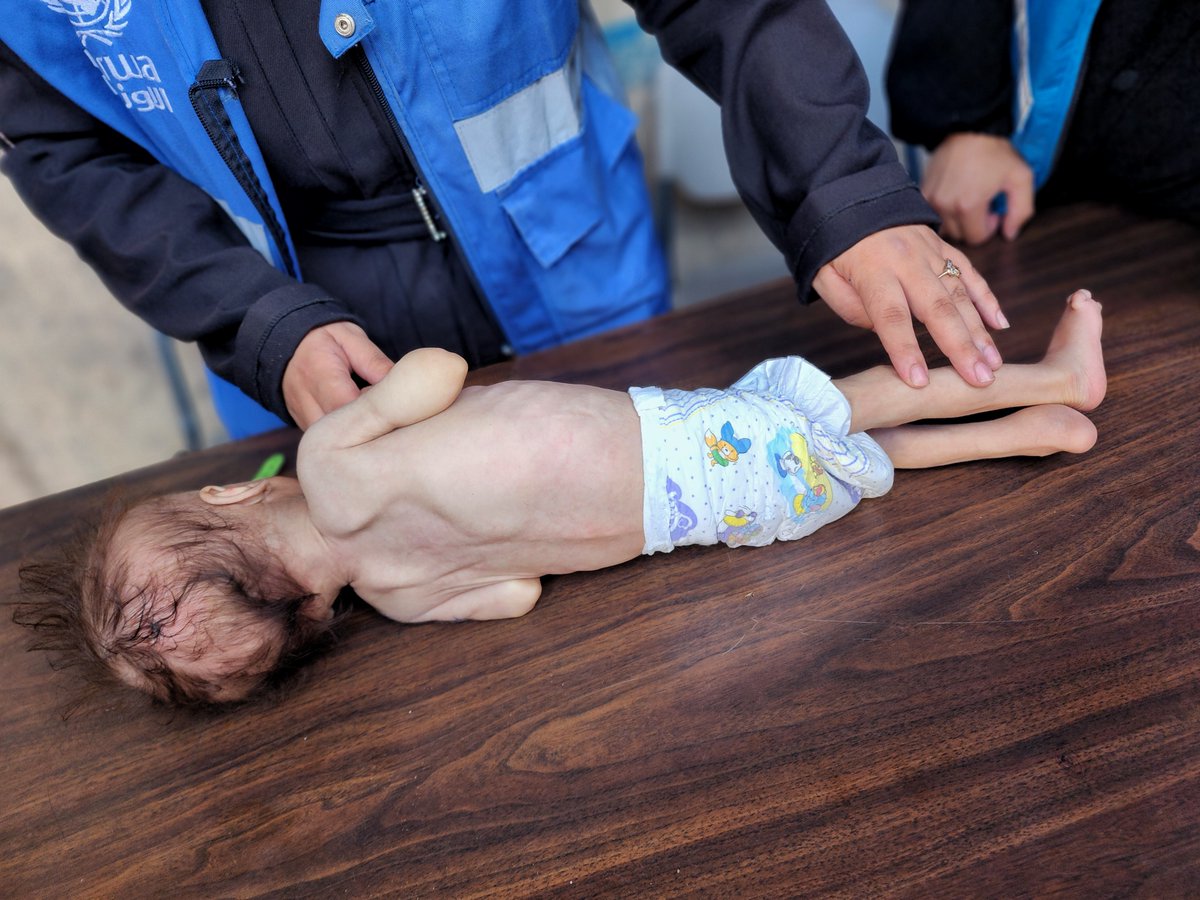 En julio, en Gaza, más de  320.000 niños y niñas, es decir, toda la población menor de cinco años, corrían riesgo de sufrir desnutrición aguda.
Además, miles de ellos ya padecían desnutrición aguda severa, la fase más mortal de la desnutrición. 
El asedio debe levantarse ya.