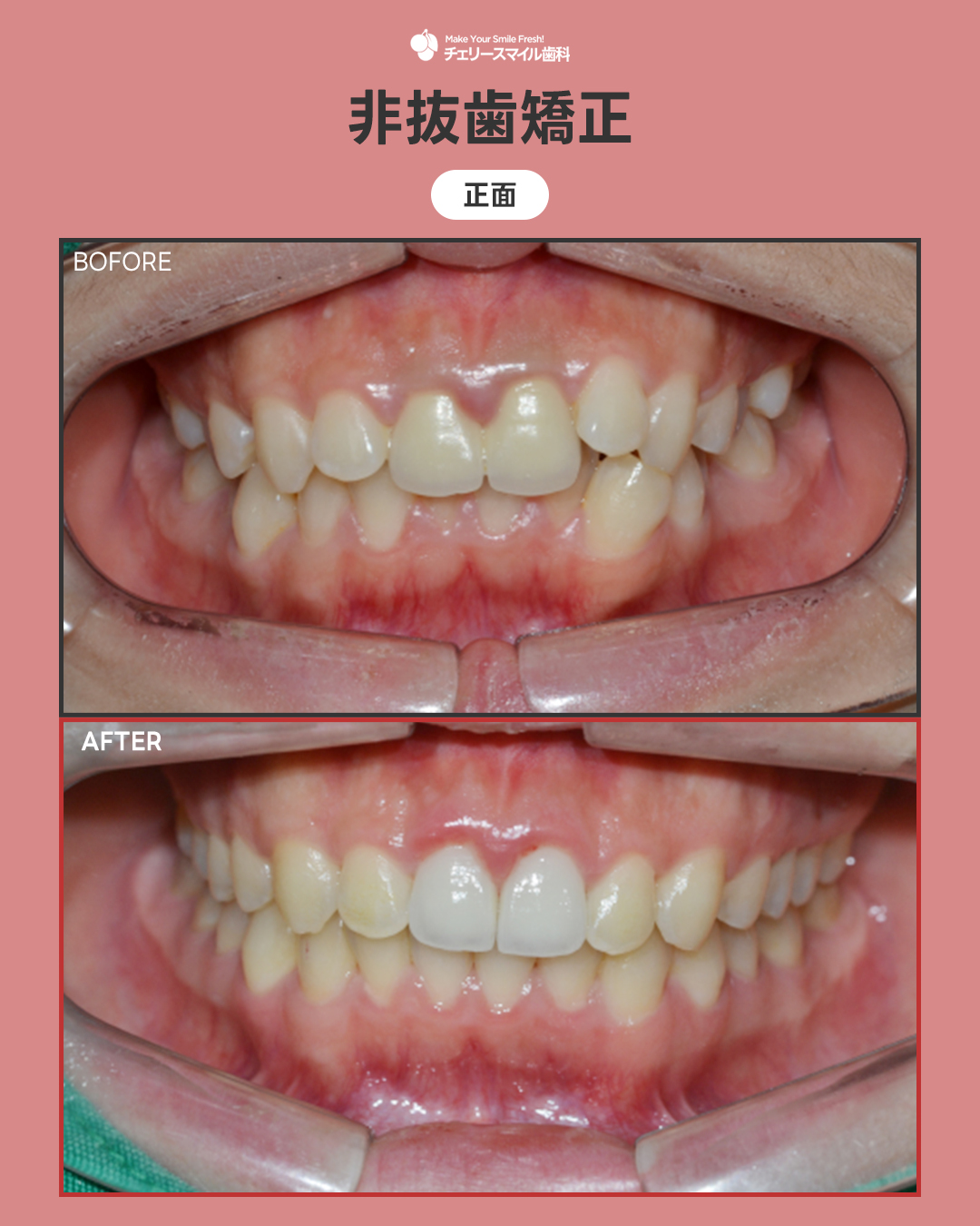 非抜歯矯正 5b43b5ad32321a0876c14757c02eb0