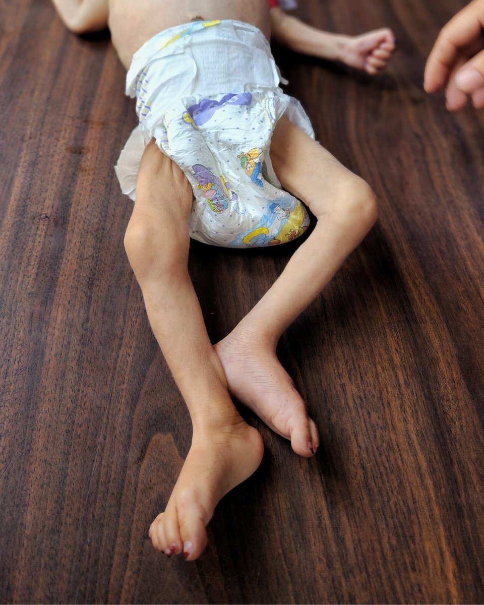 El personal de los hospitales en Gaza ha informado de un rápido aumento de fallecimientos relacionados con el hambre de menores de cinco años, con al menos 16 muertes reportadas desde el 17 de julio.